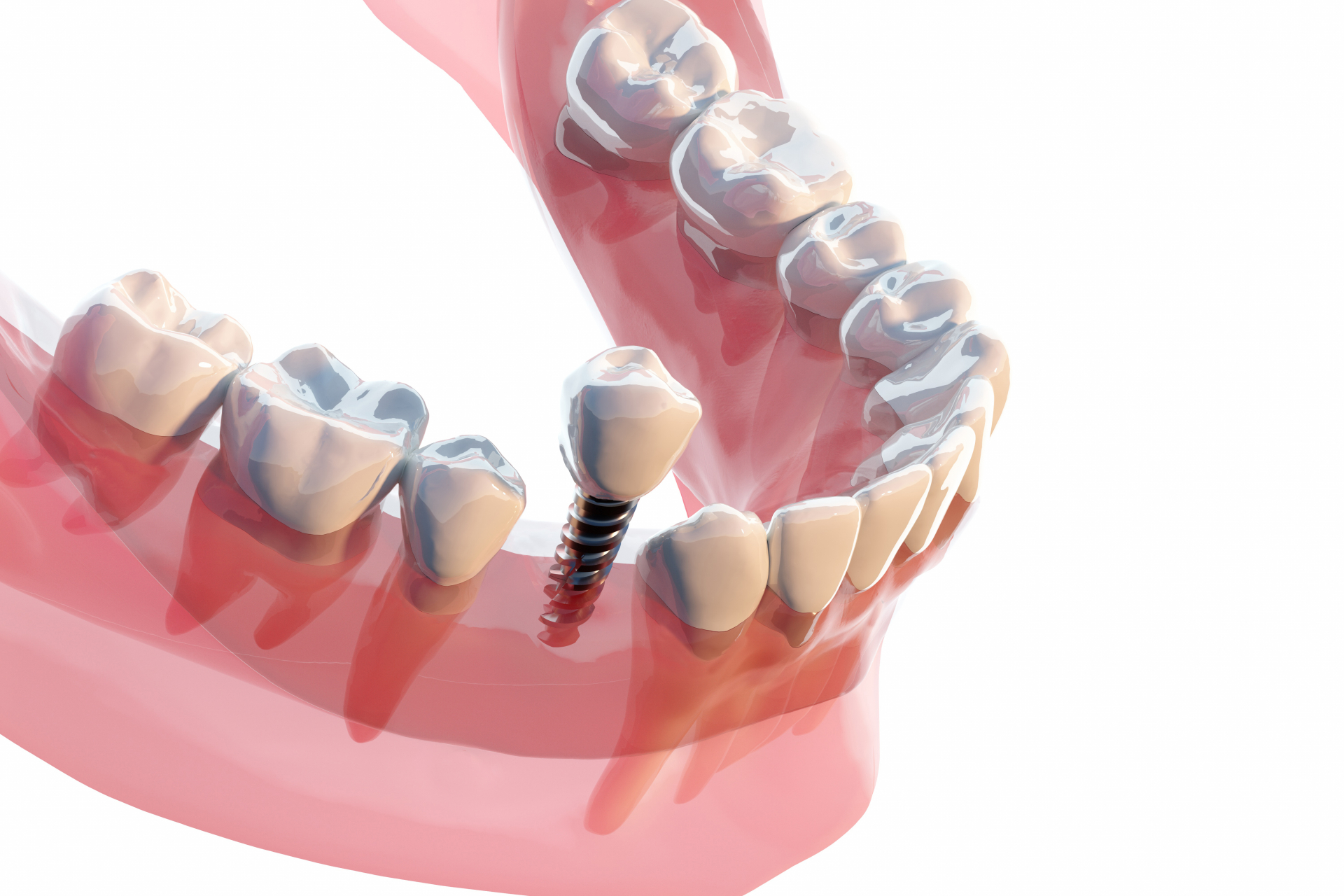 口の中に潜む細菌が引き起こす「むし歯」