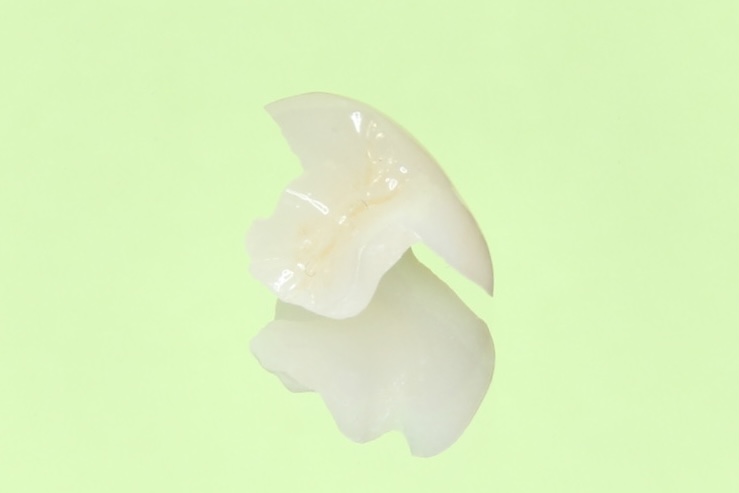 口の中に潜む細菌が引き起こす「むし歯」