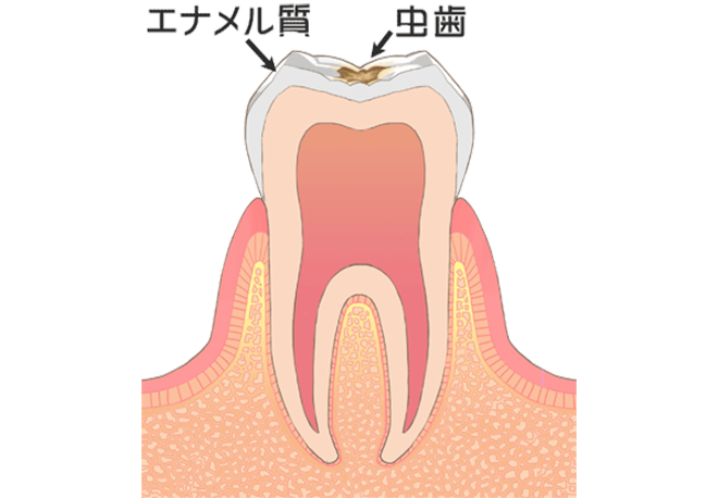 口の中に潜む細菌が引き起こす「むし歯」