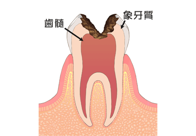 口の中に潜む細菌が引き起こす「むし歯」
