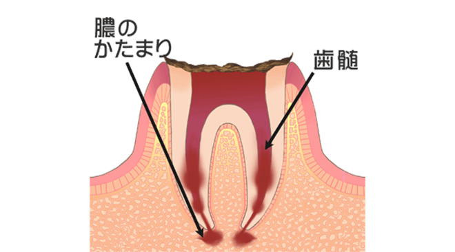 口の中に潜む細菌が引き起こす「むし歯」